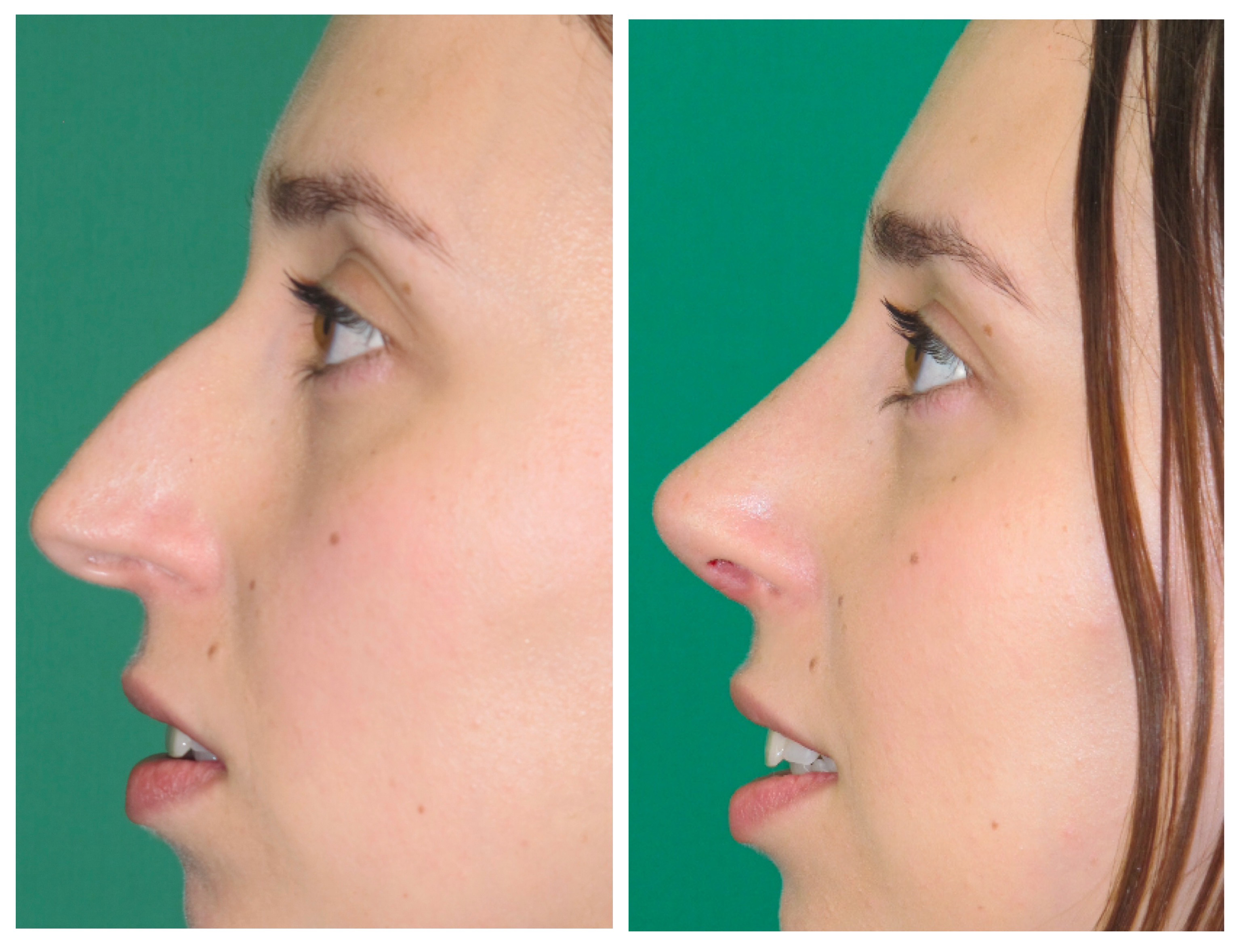 Resultados Rinoplastia Funcional