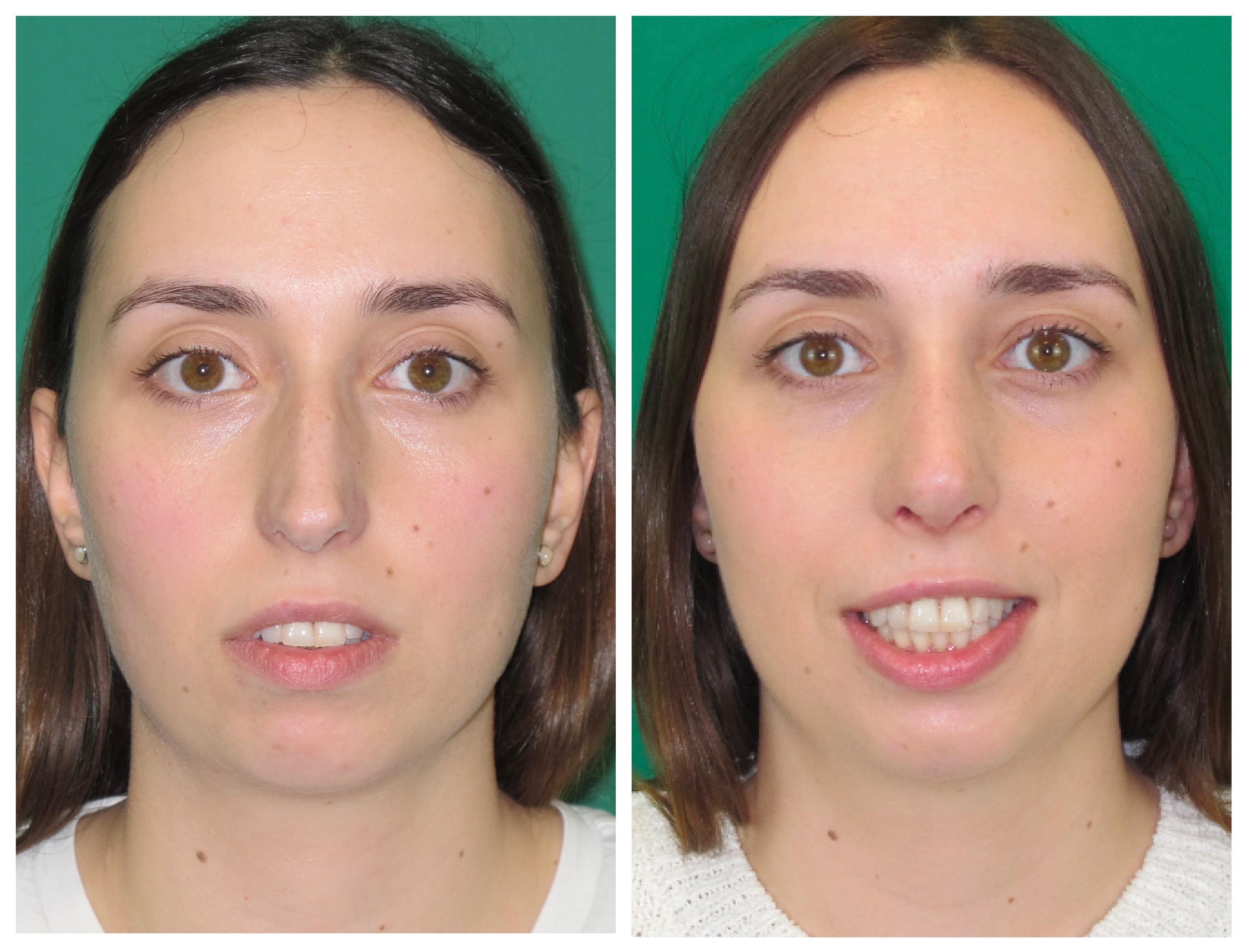 Resultados Rinoplastia Funcional