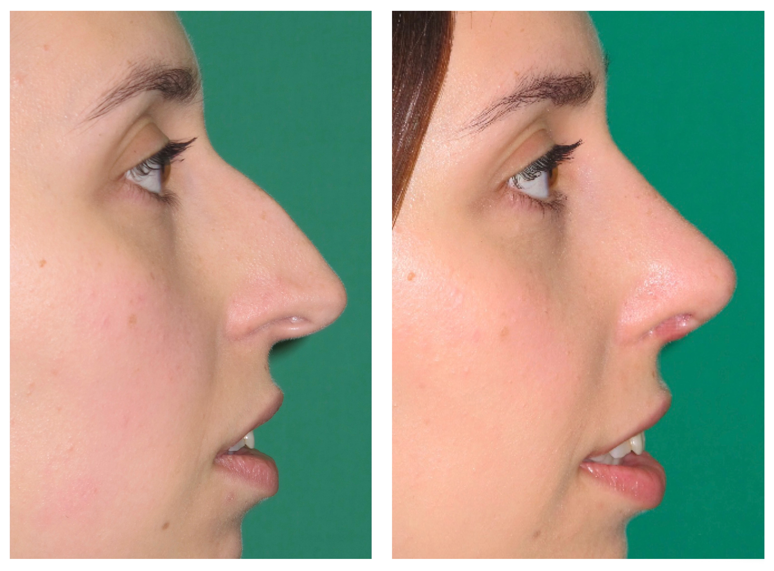 Resultados Rinoplastia Funcional