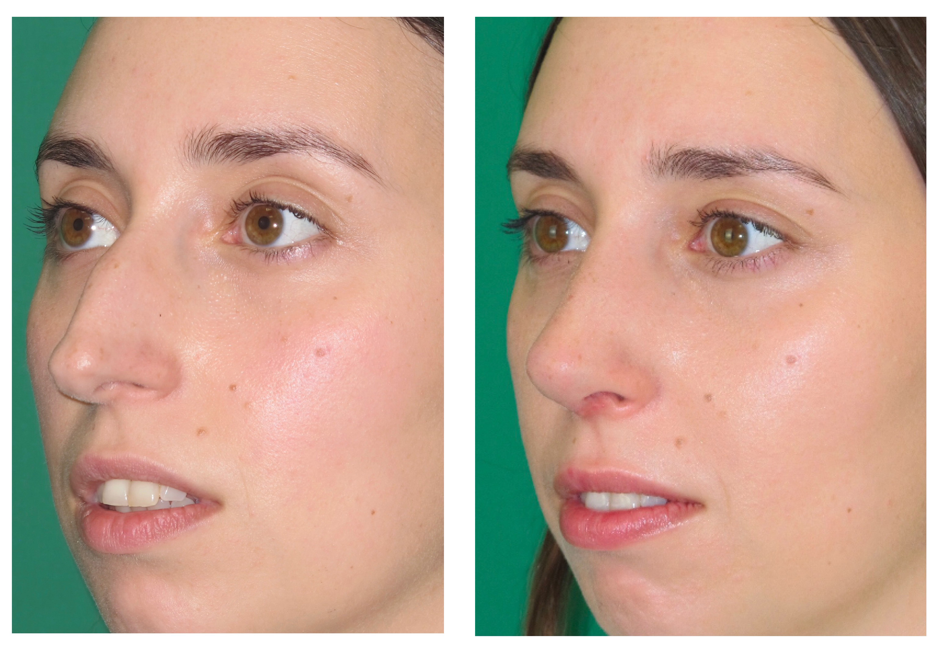 Resultados Rinoplastia Funcional