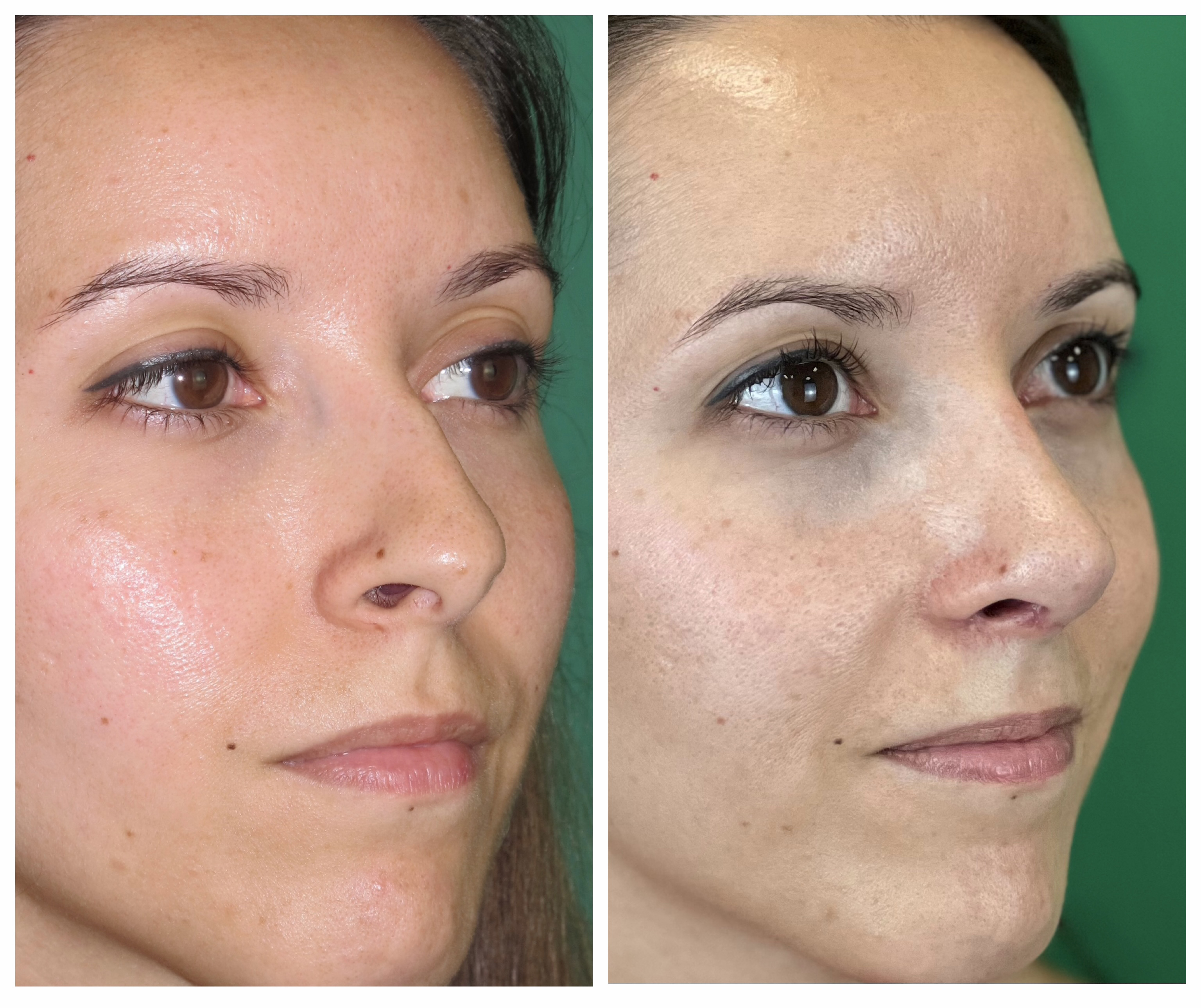 Resultados Rinoplastia Funcional