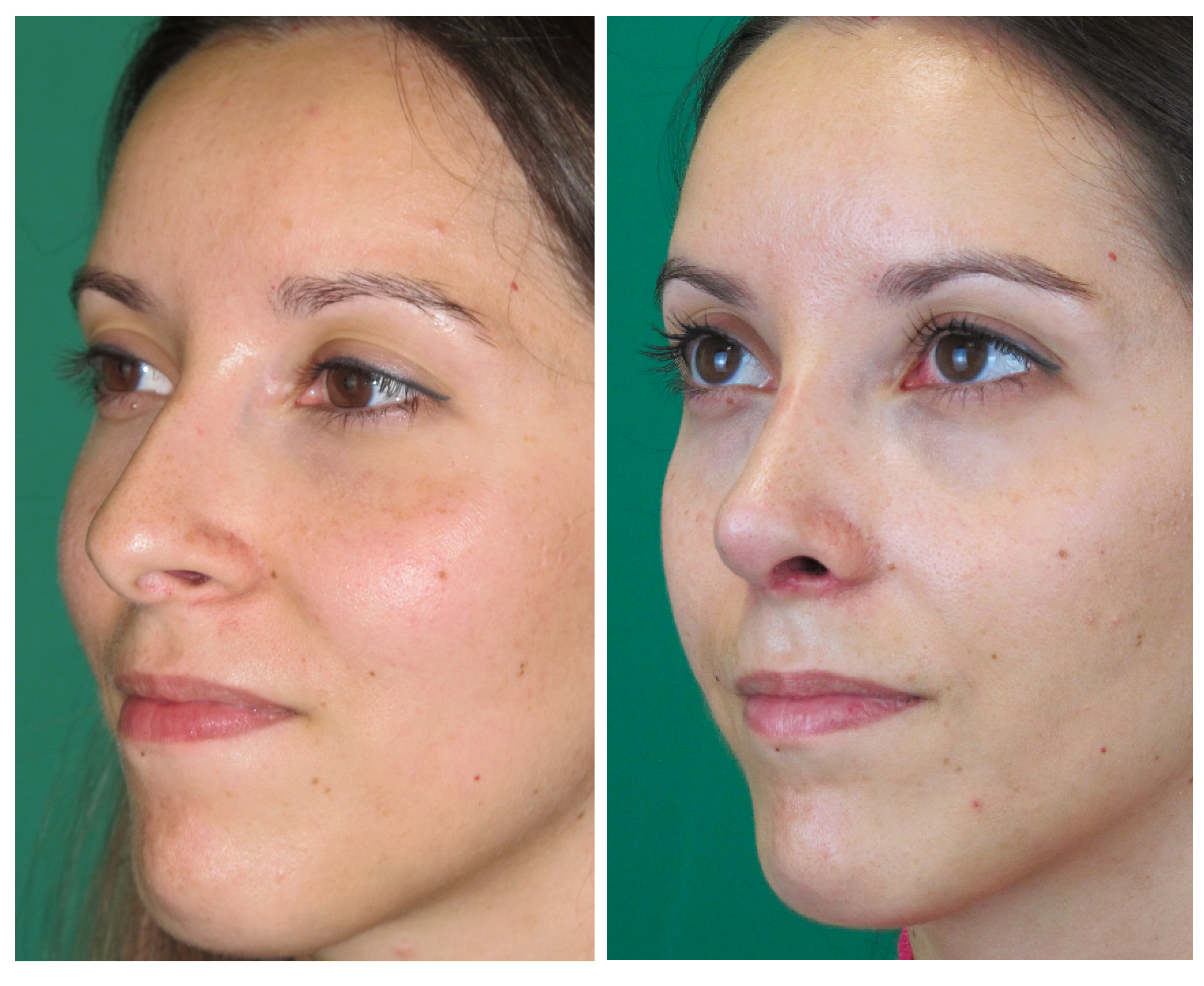 Resultados Rinoplastia Funcional