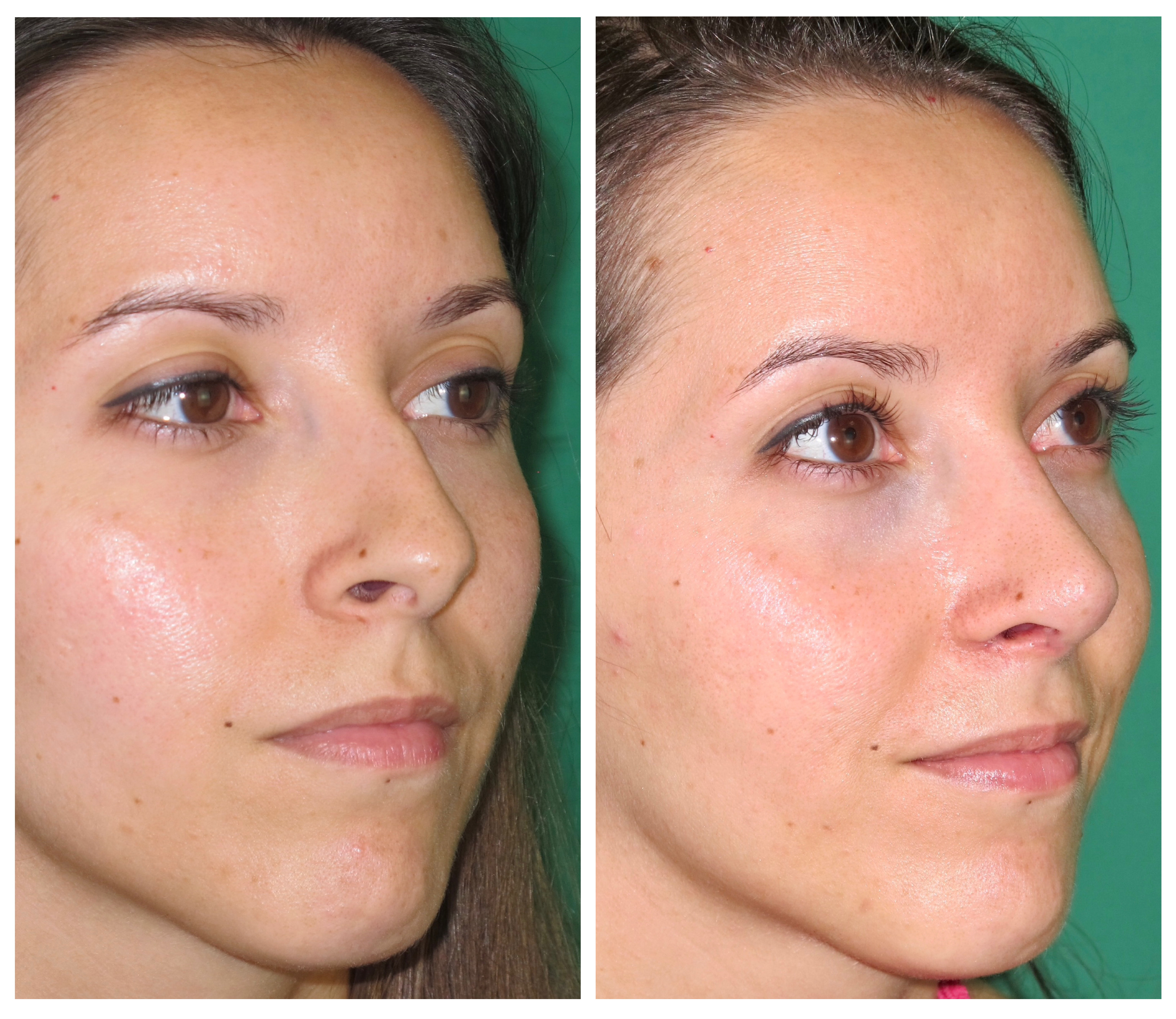Resultados Rinoplastia Funcional