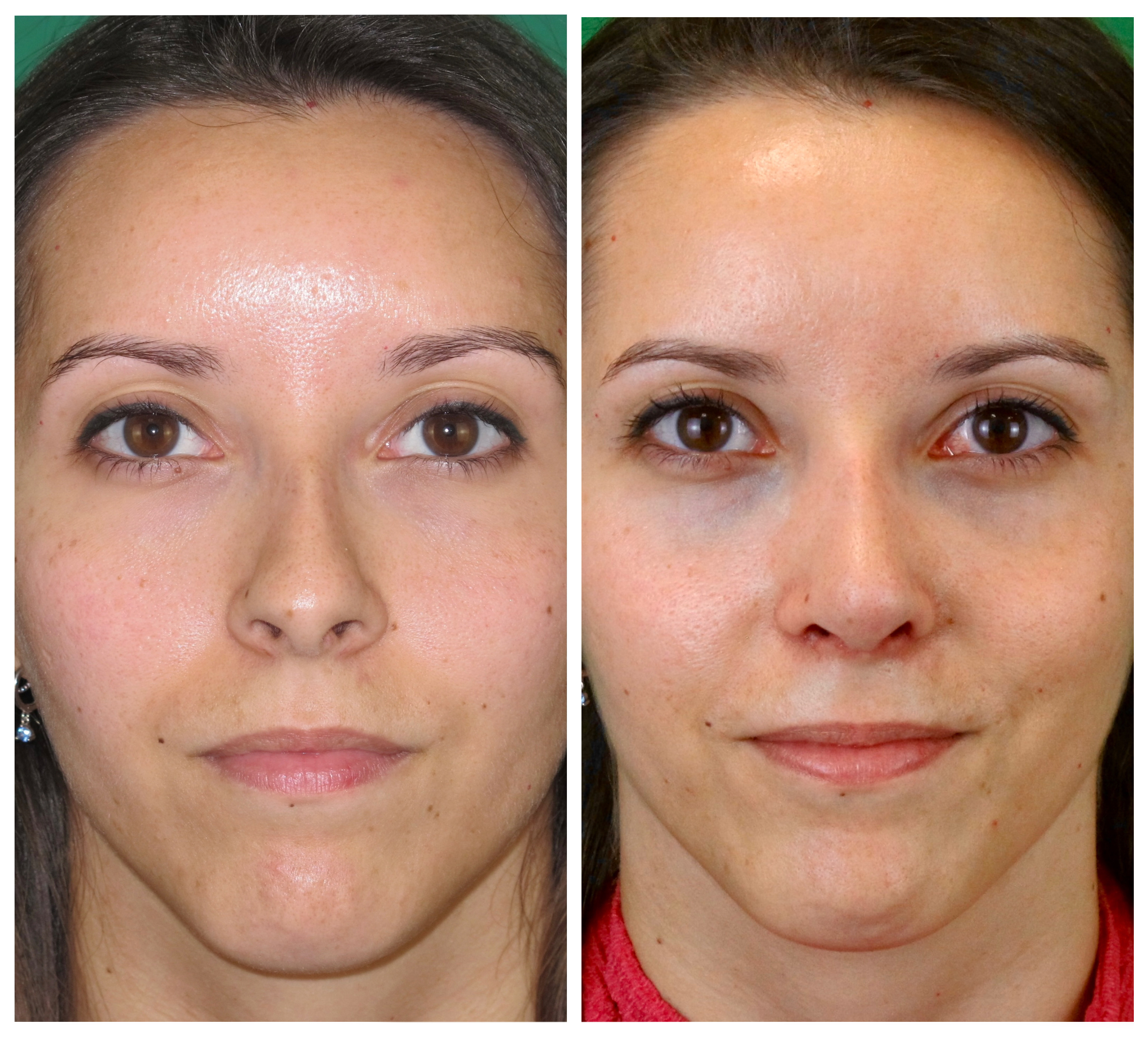 Resultados Rinoplastia Funcional