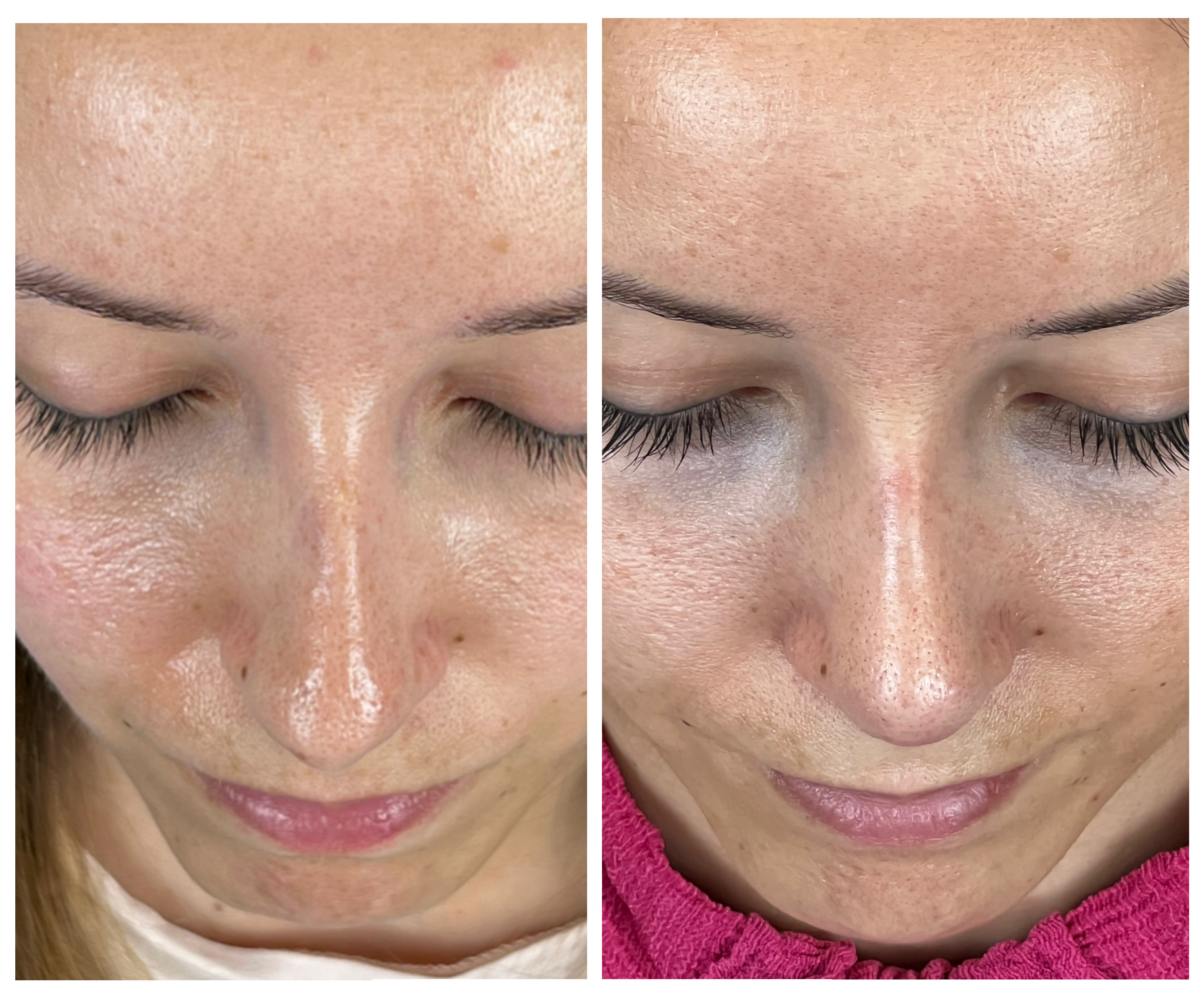 Resultados Rinoplastia Funcional
