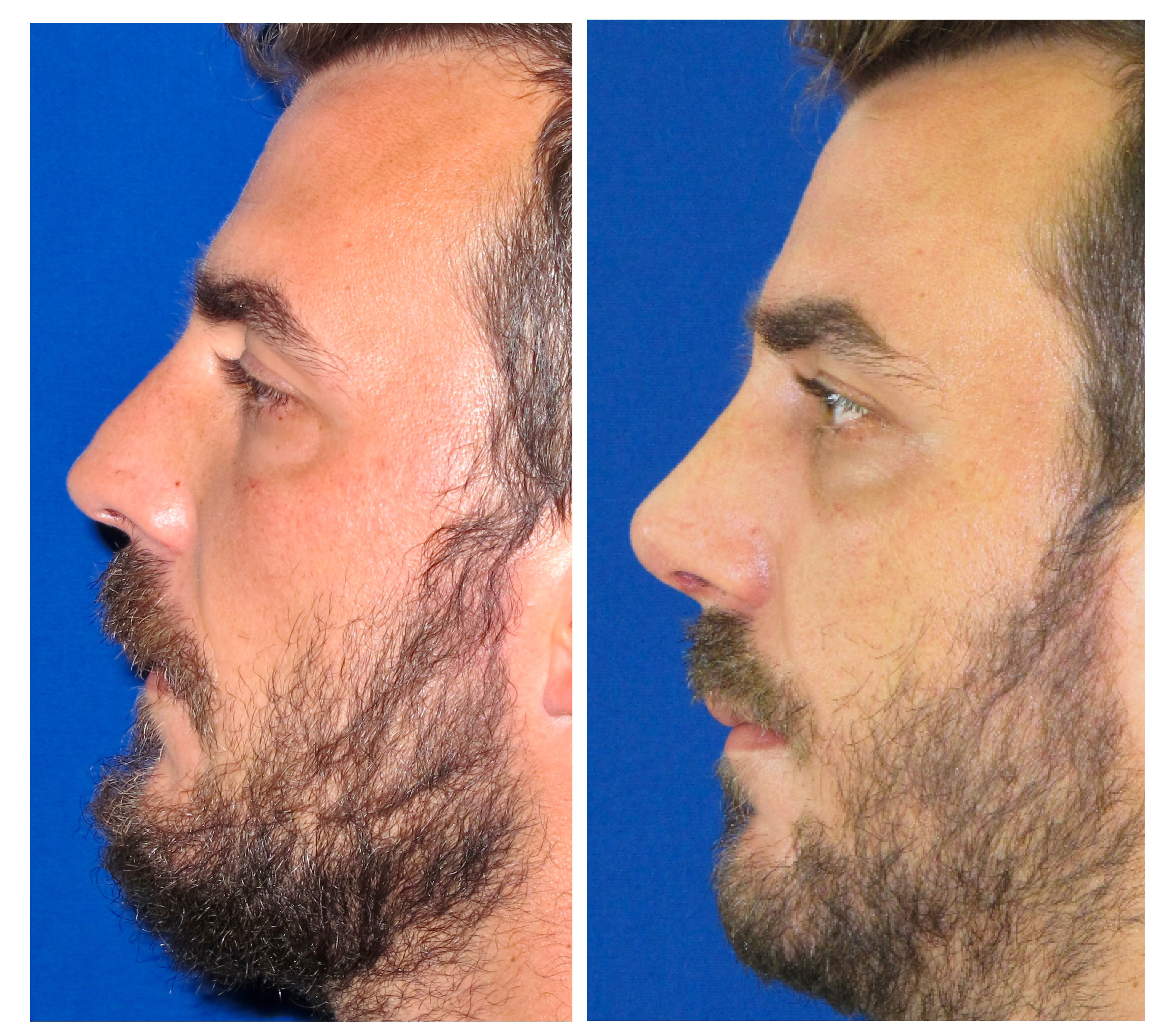 Resultados Rinoplastia Funcional