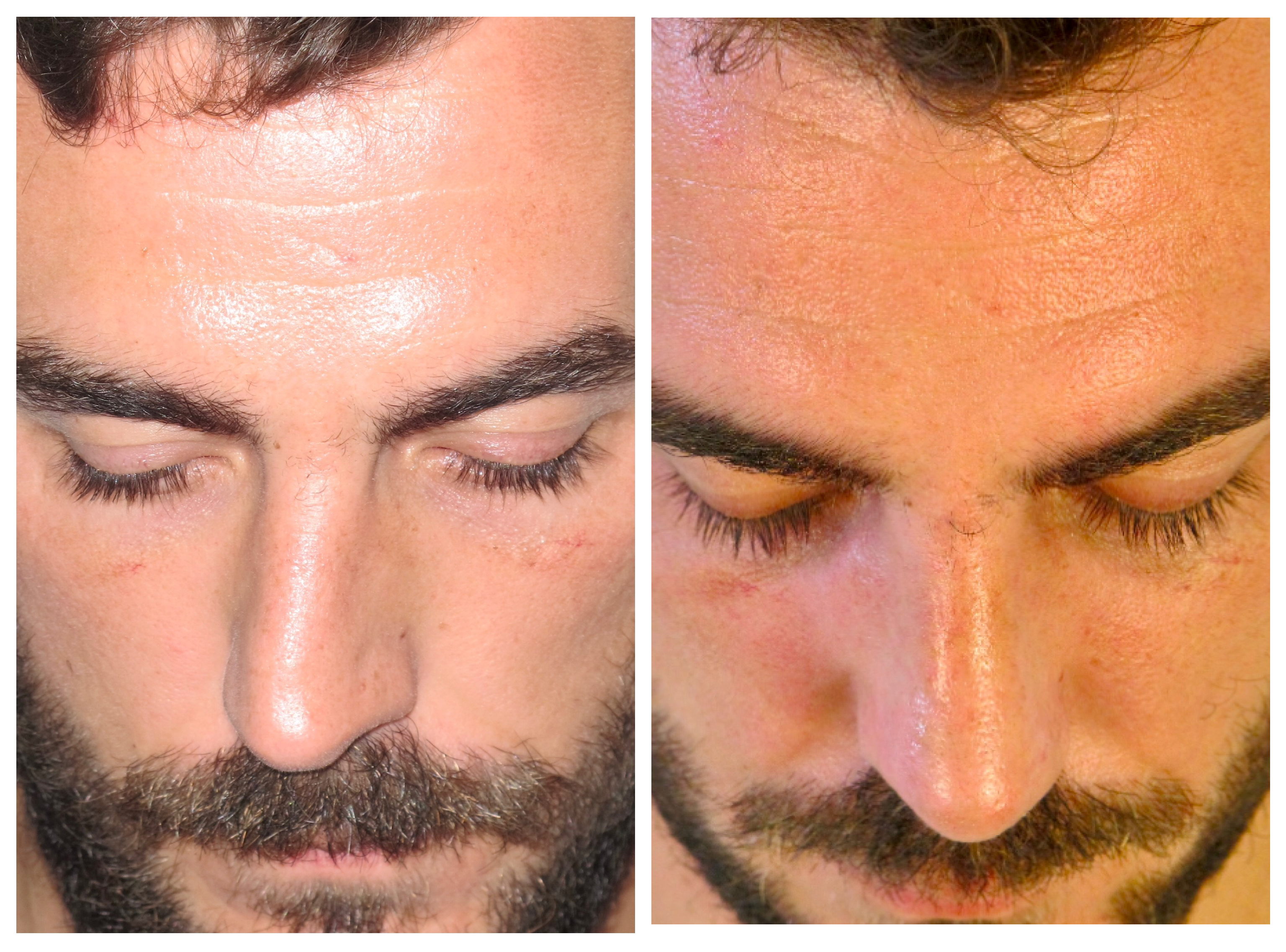 Resultados Rinoplastia Funcional