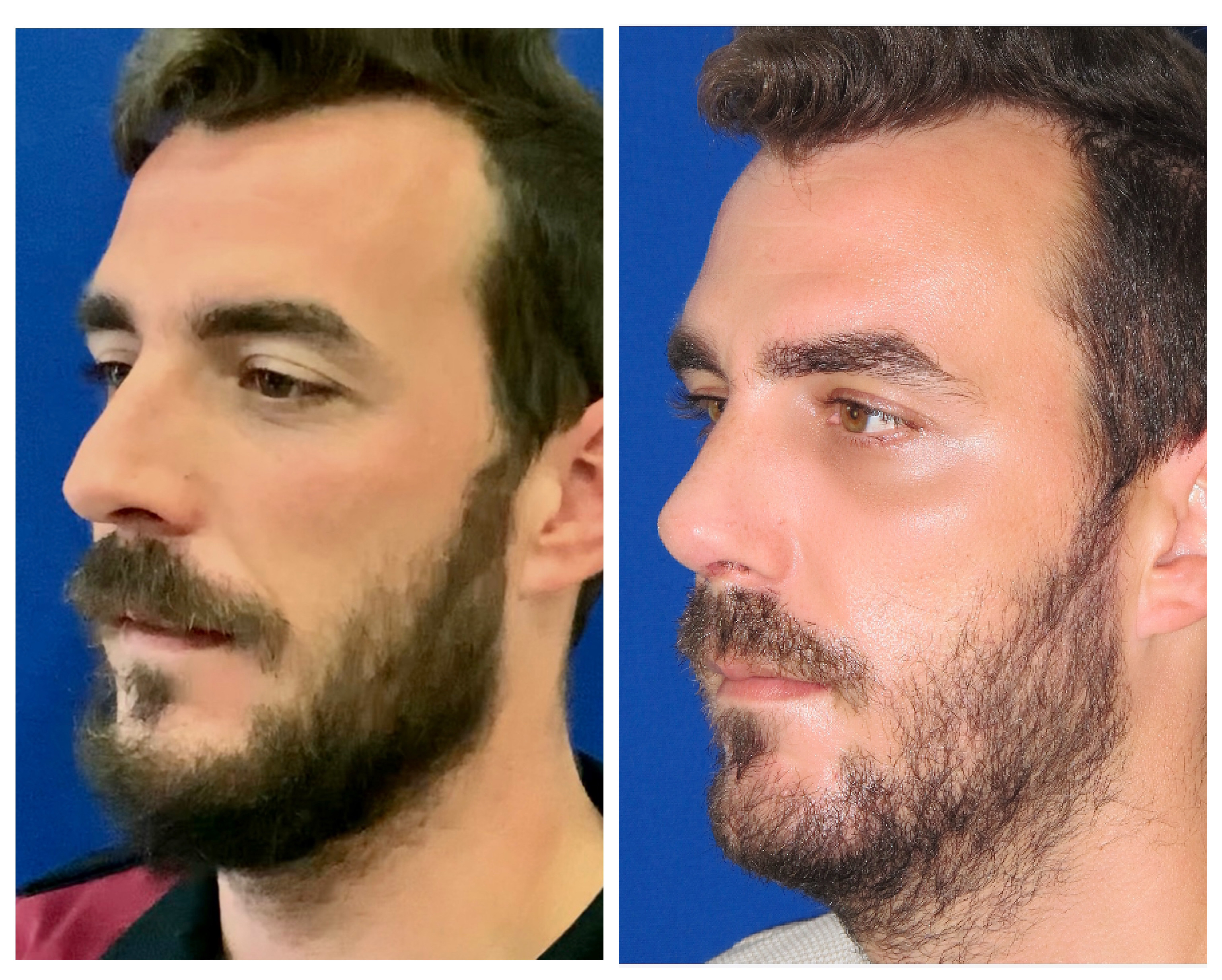 Resultados Rinoplastia Funcional