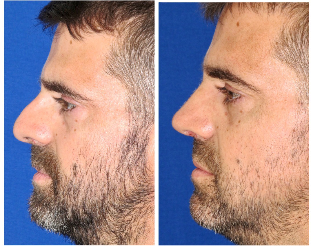 Resultados Rinoplastia Funcional
