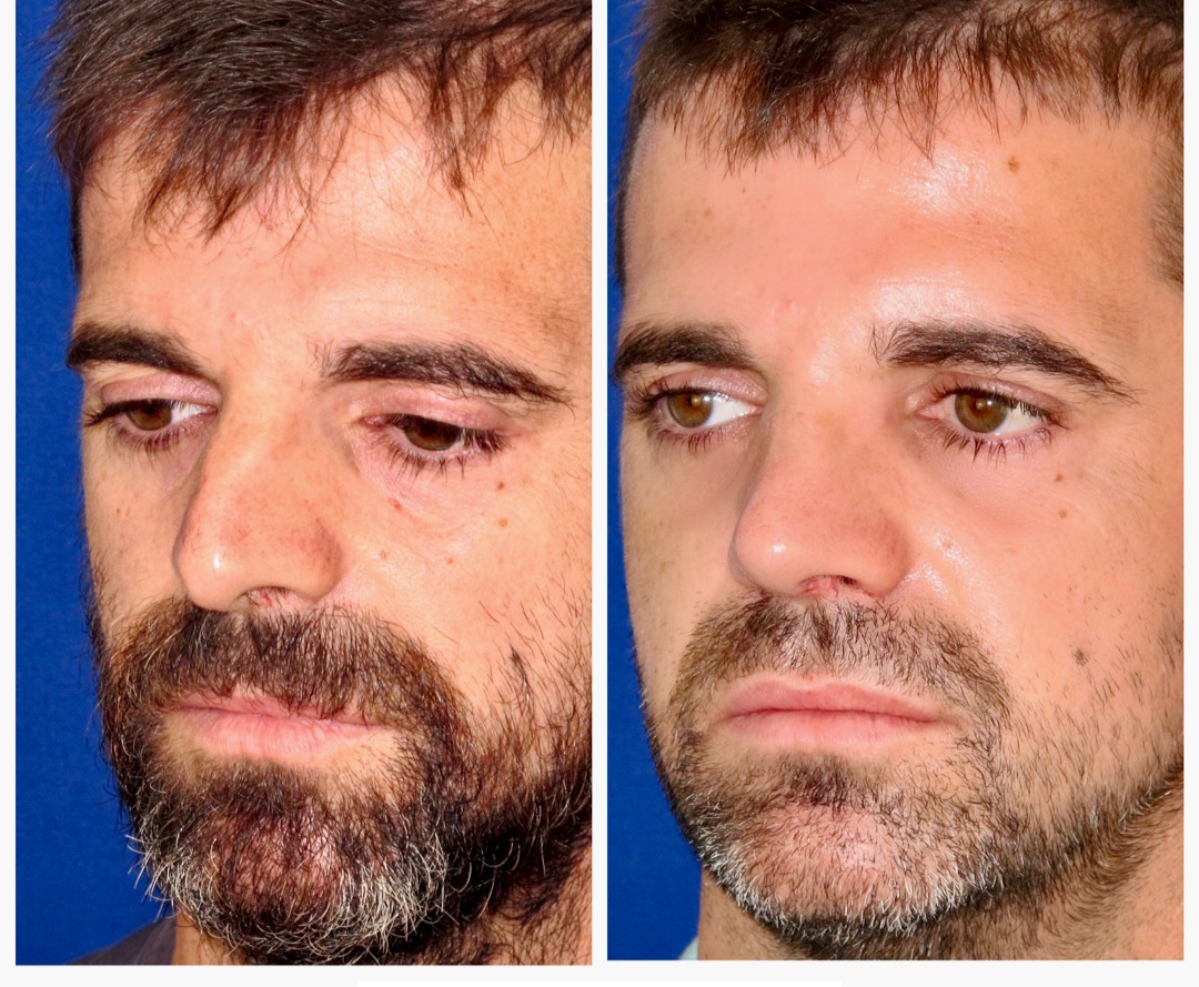 Resultados Rinoplastia Funcional