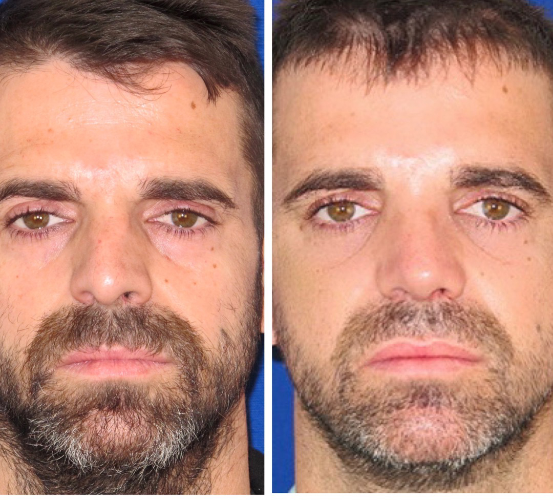 Resultados Rinoplastia Funcional
