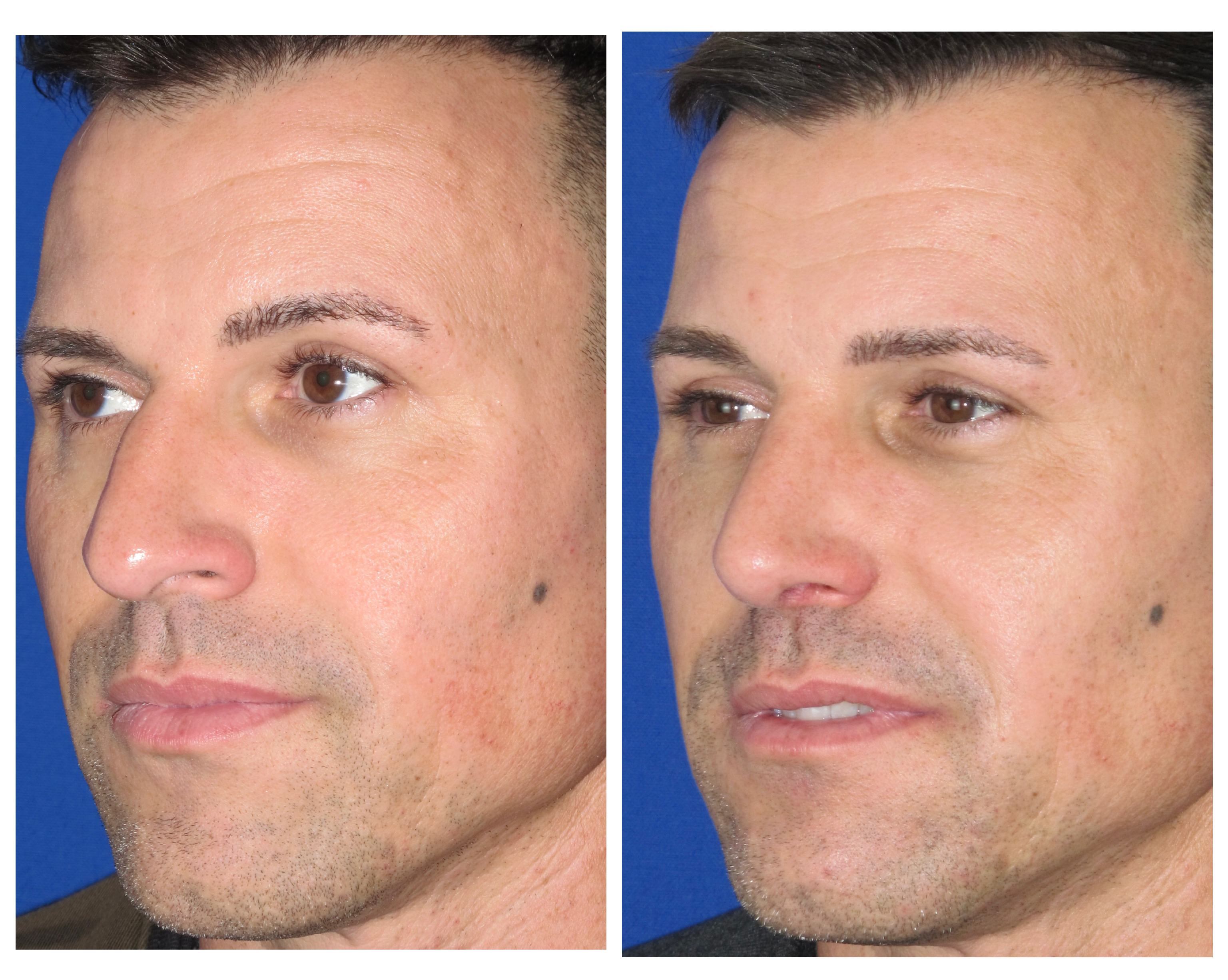 Resultados Rinoplastia Funcional