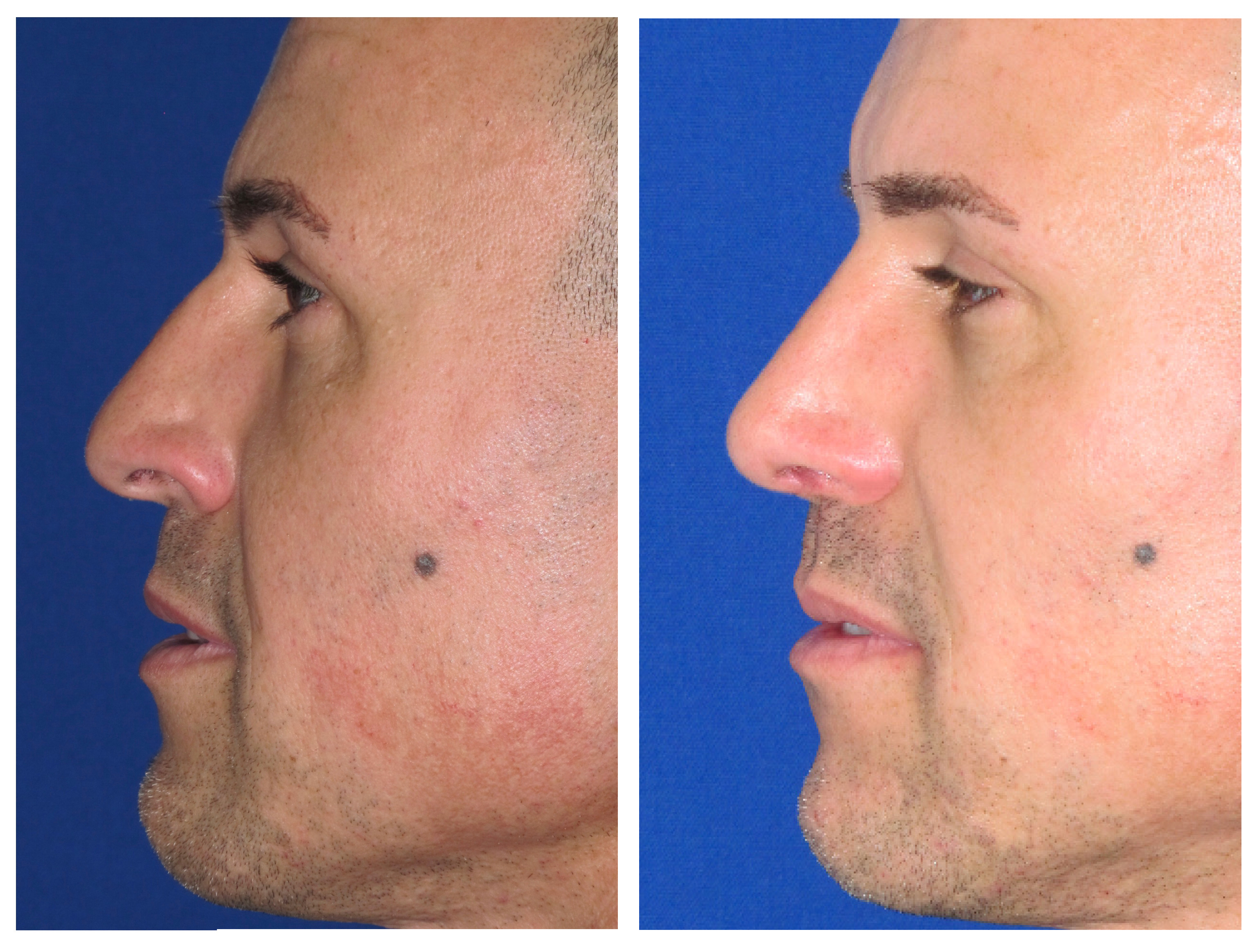 Resultados Rinoplastia Funcional