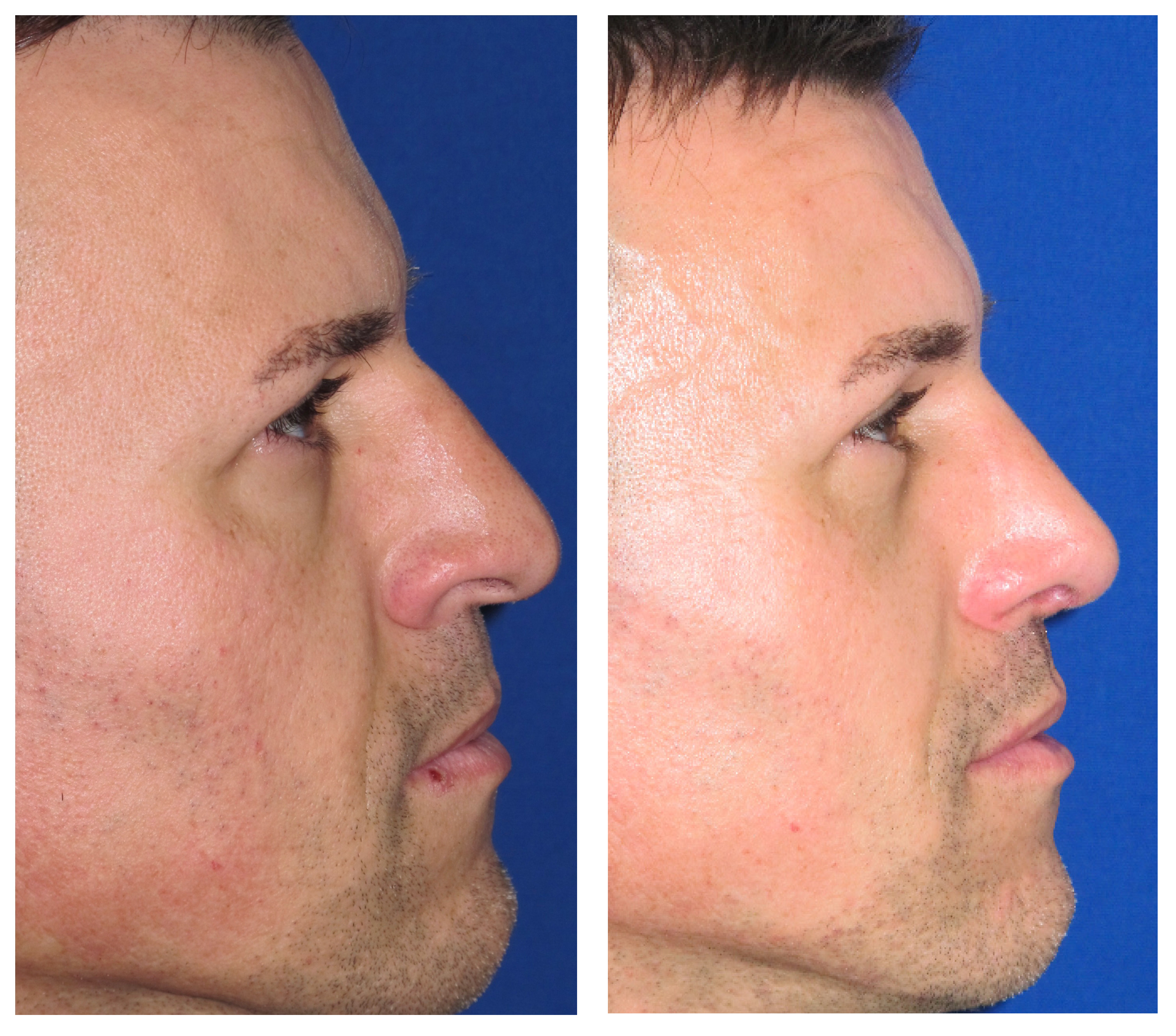 Resultados Rinoplastia Funcional