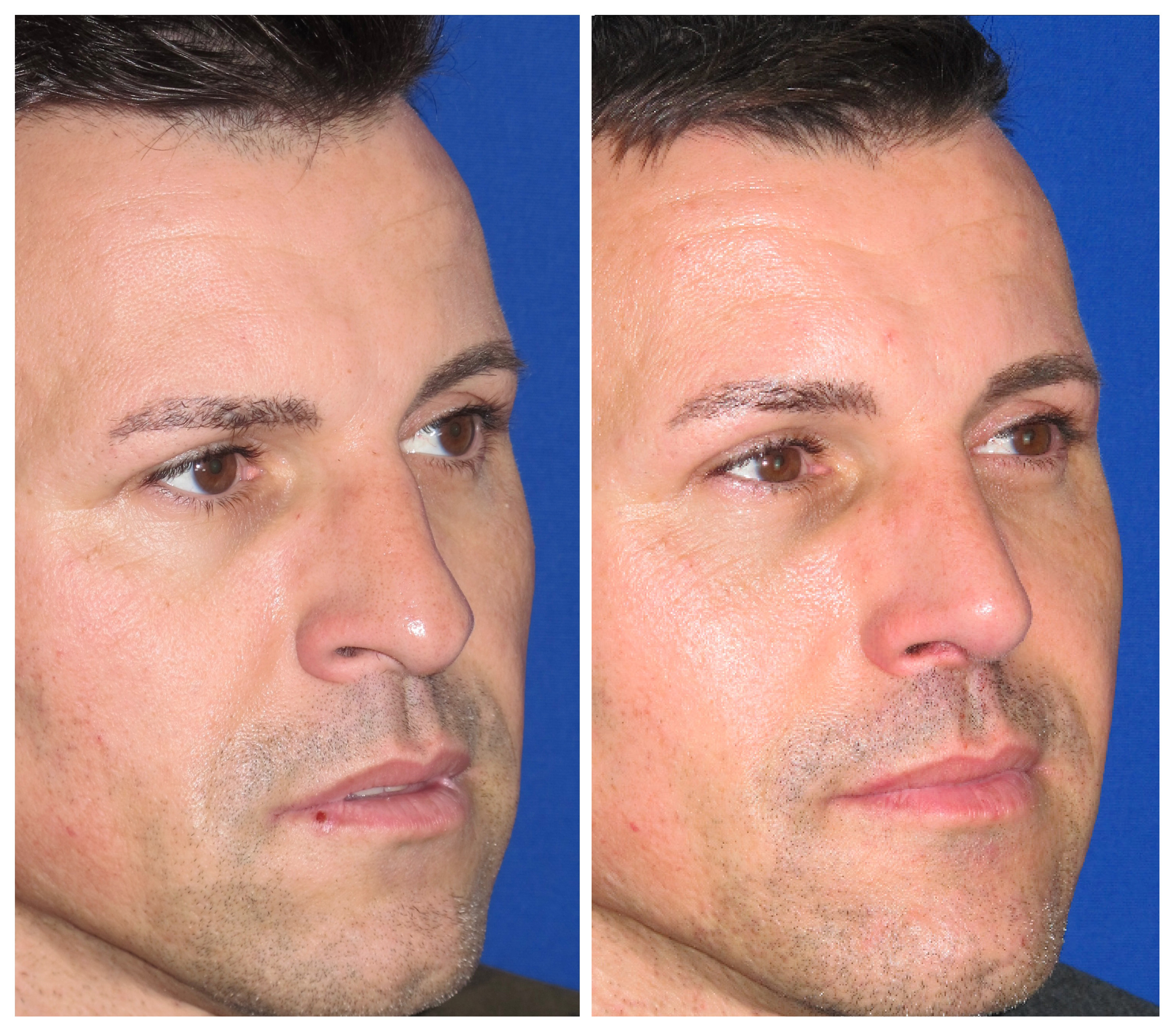Resultados Rinoplastia Funcional