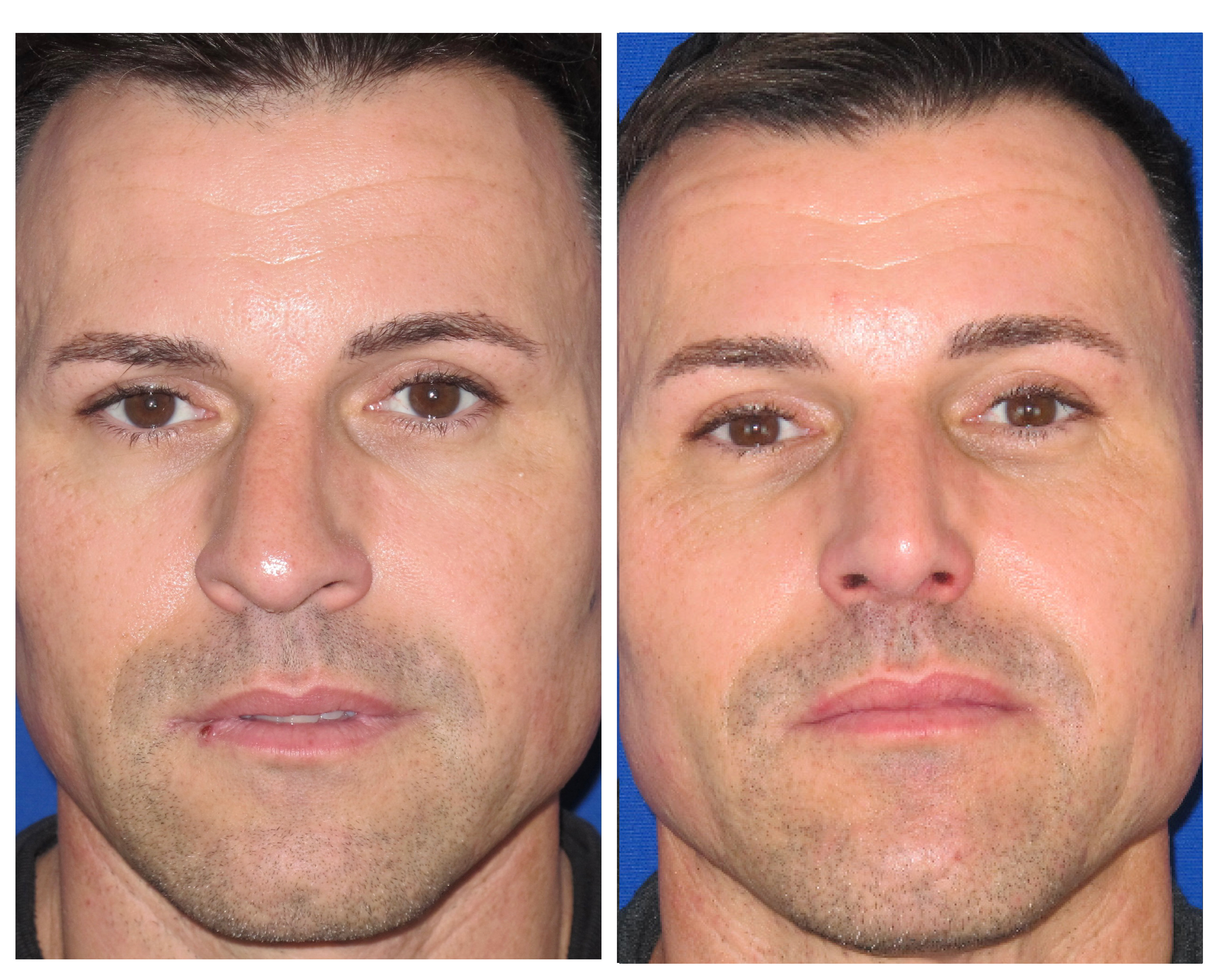 Resultados Rinoplastia Funcional