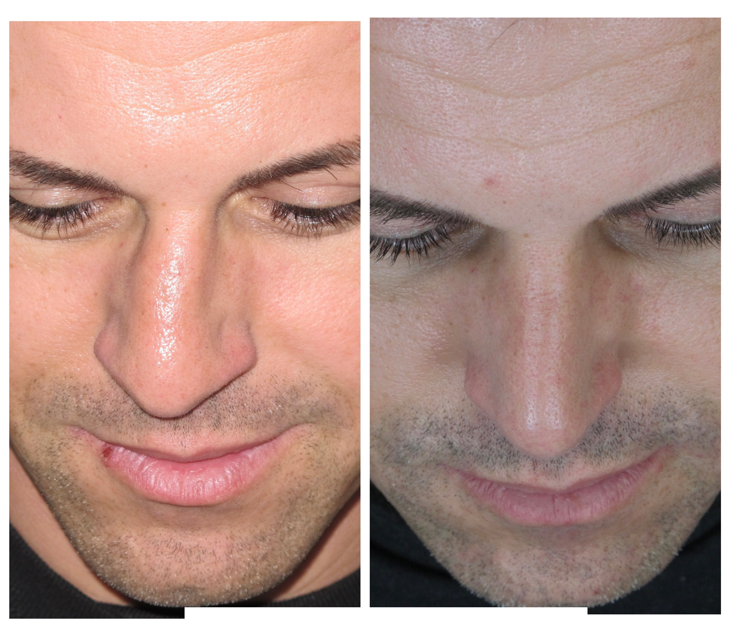 Resultados Rinoplastia Funcional