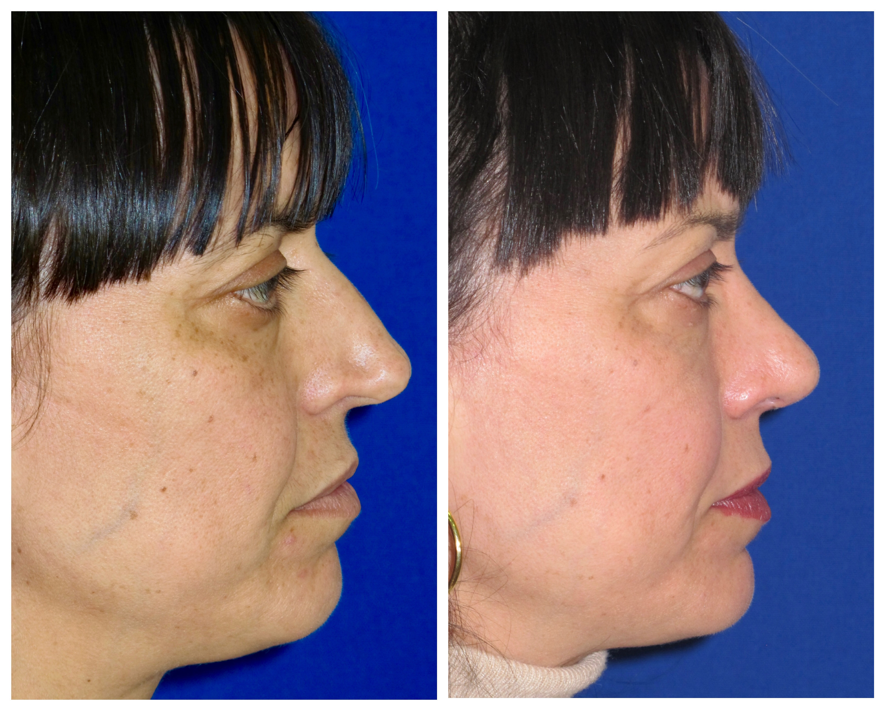 Resultados Rinoplastia Funcional