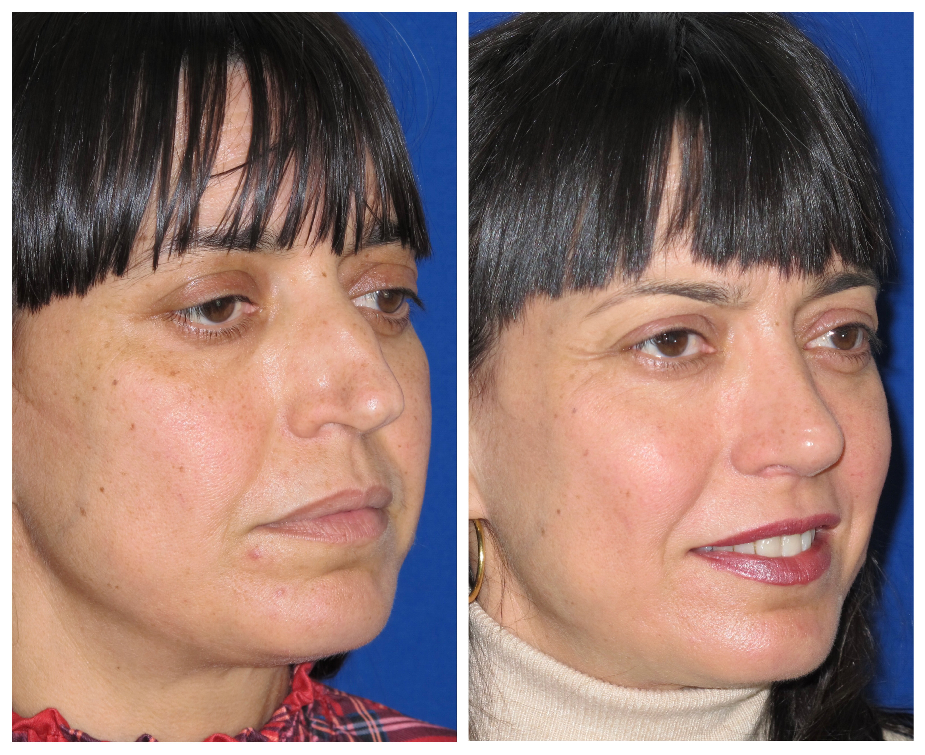 Resultados Rinoplastia Funcional