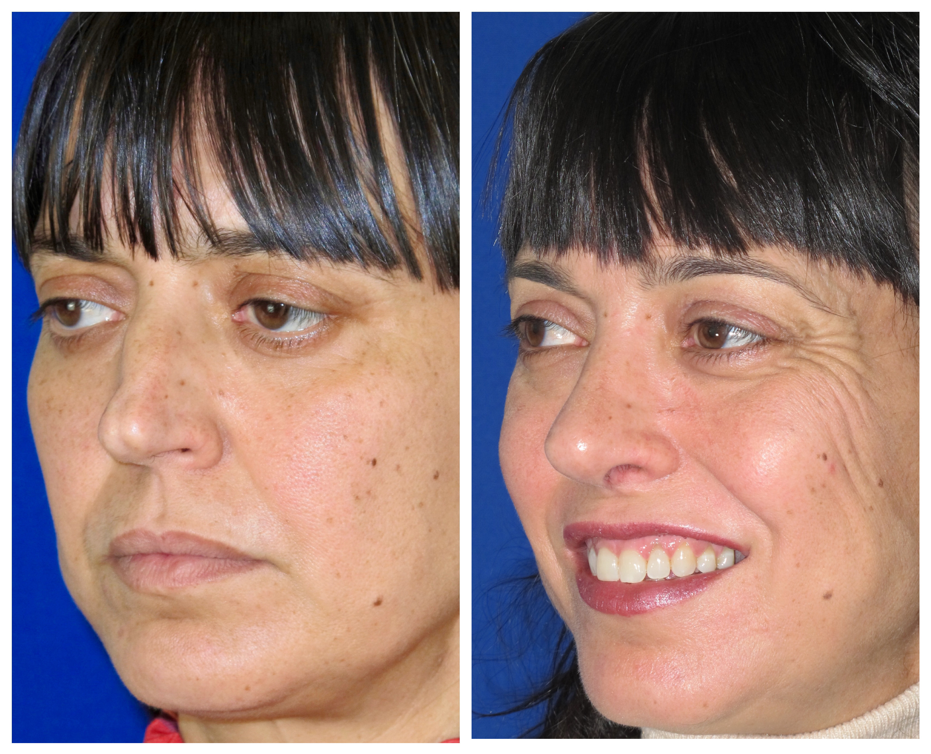 Resultados Rinoplastia Funcional
