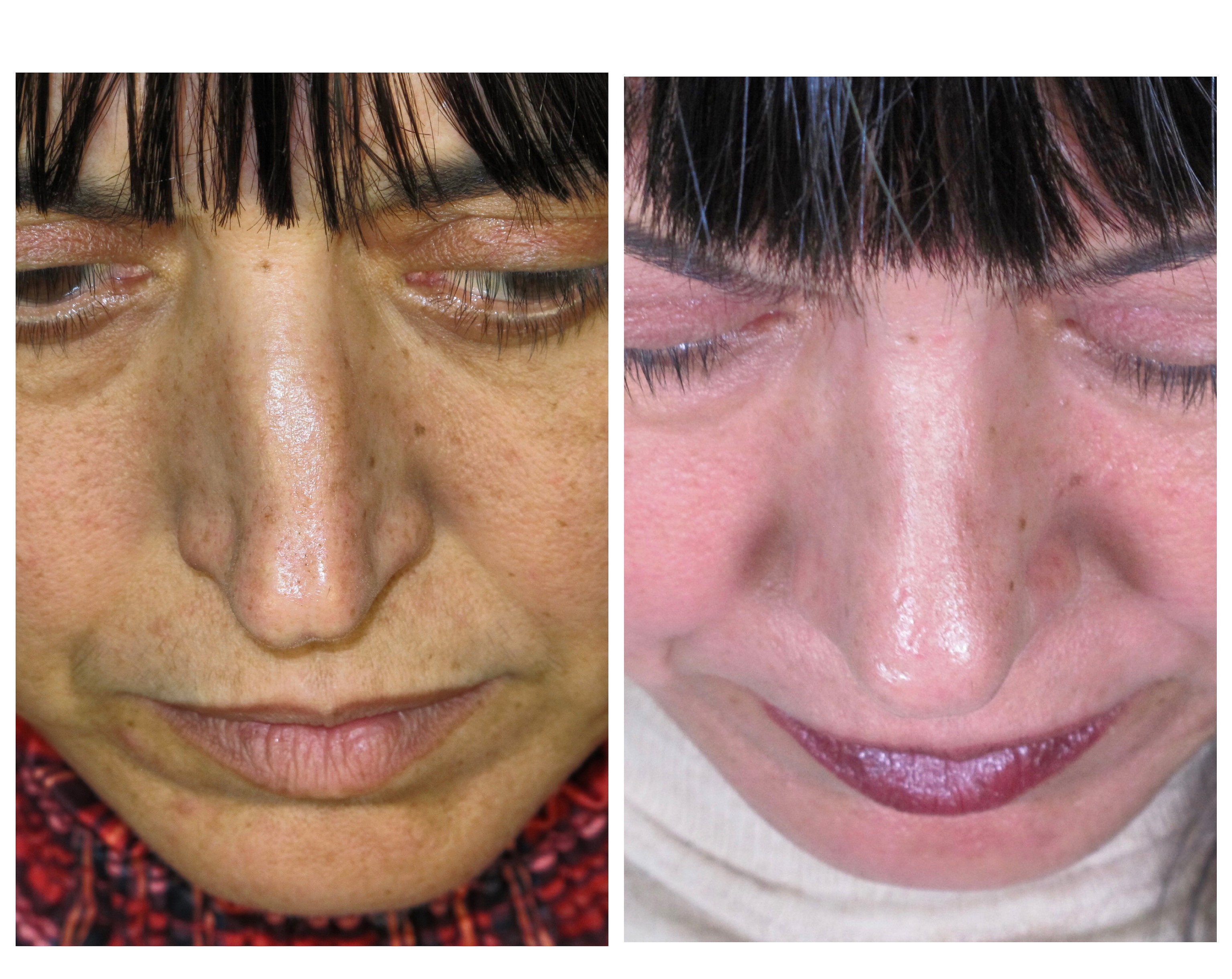Resultados Rinoplastia Funcional