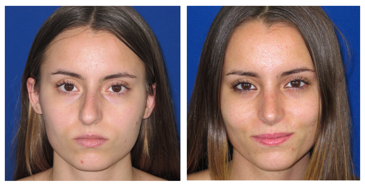 Resultados Rinoplastia Funcional