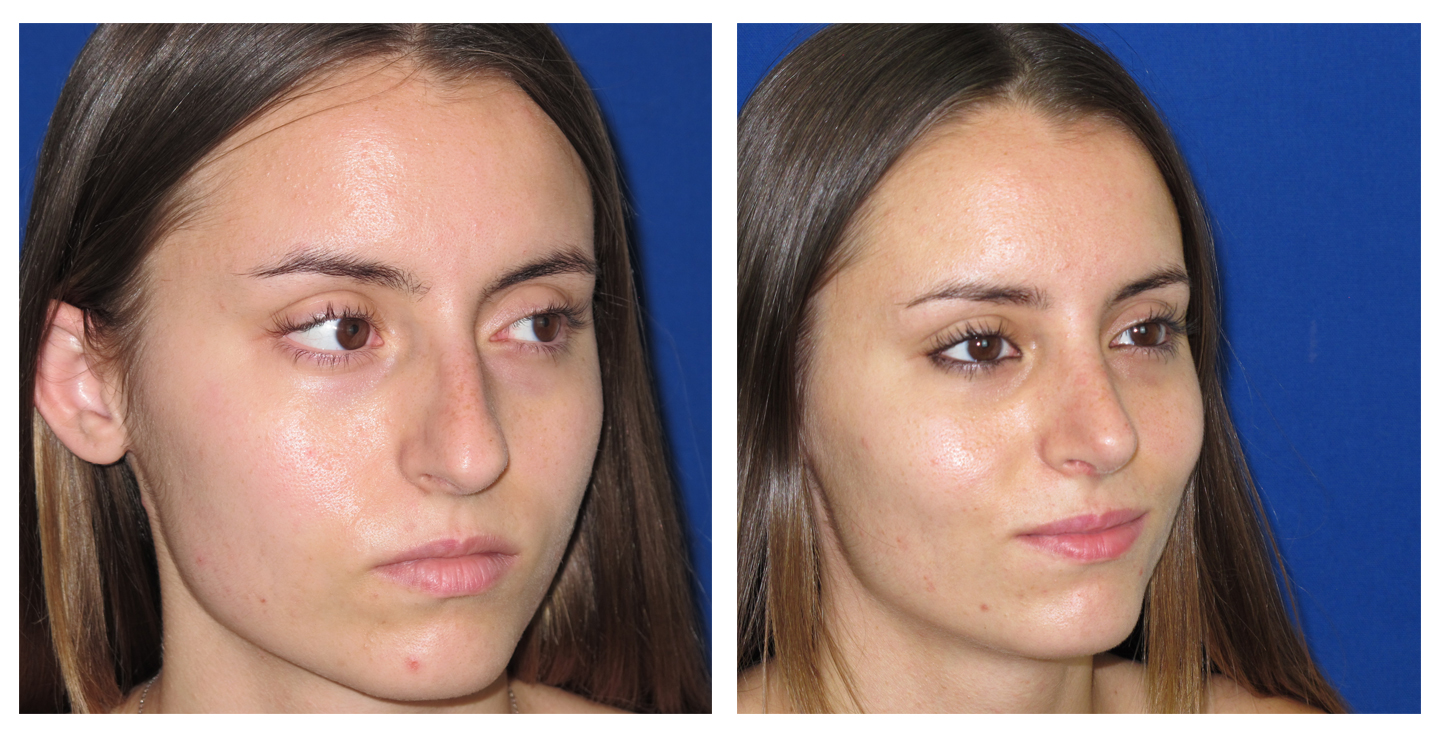 Resultados Rinoplastia Funcional
