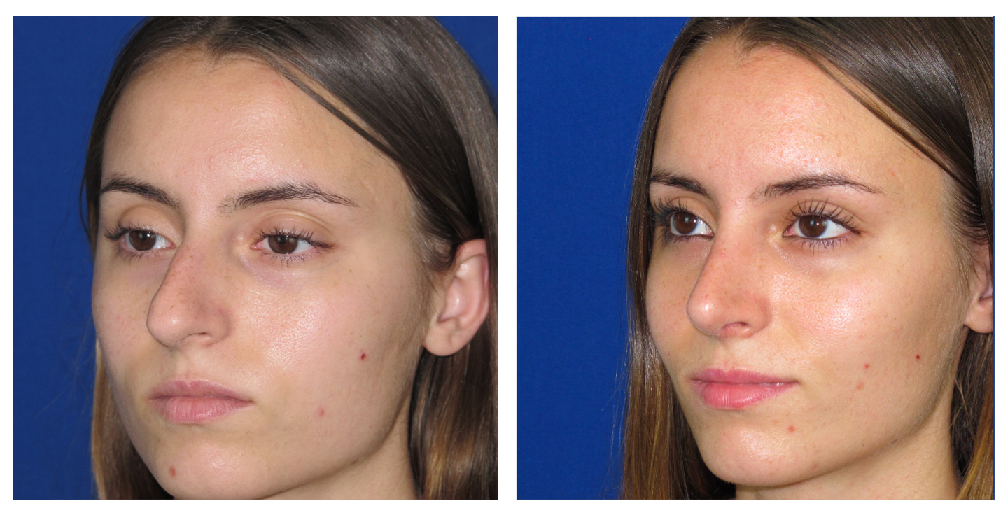 Resultados Rinoplastia Funcional