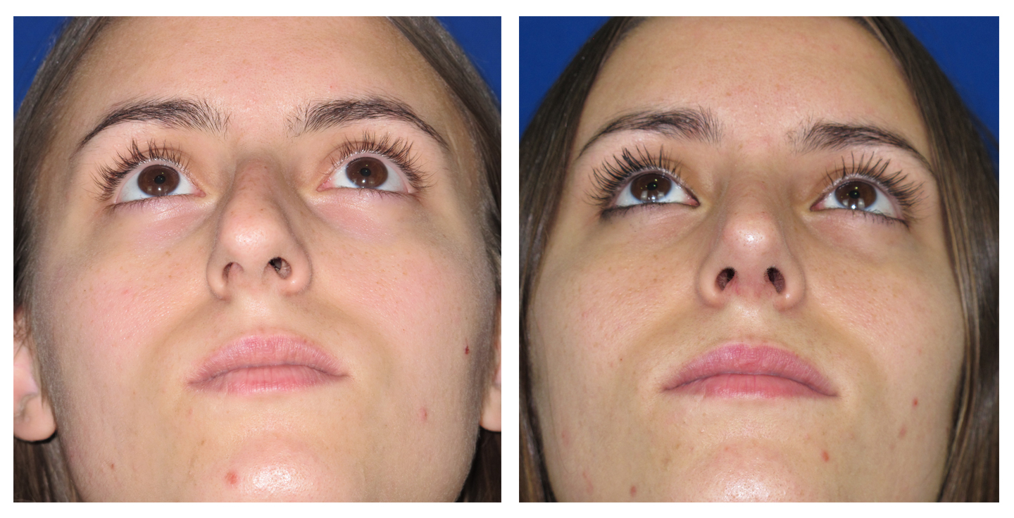 Resultados Rinoplastia Funcional