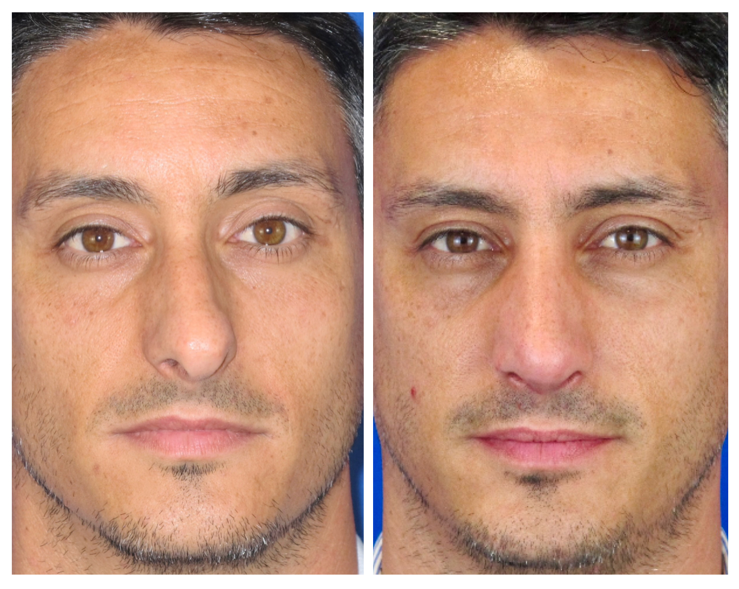 Resultados Rinoplastia Funcional