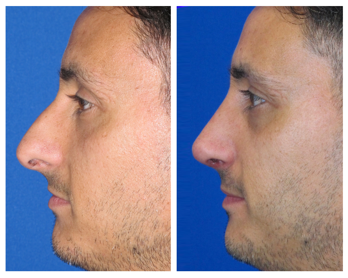 Resultados Rinoplastia Funcional