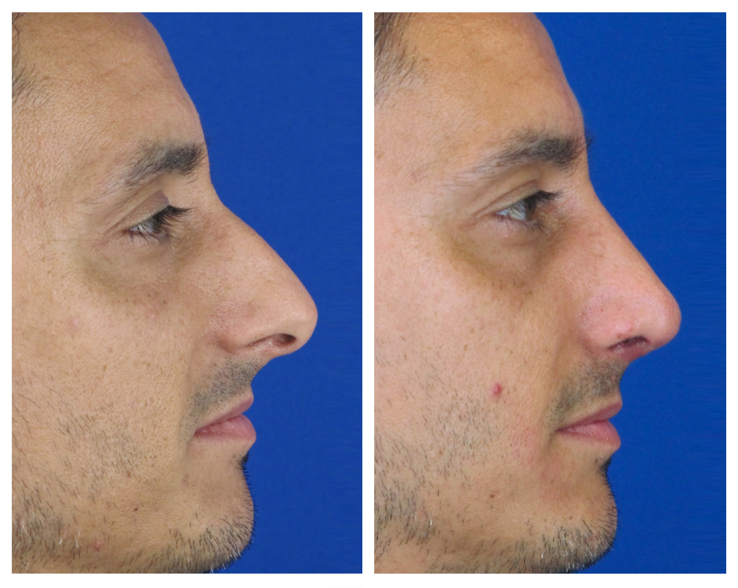 Resultados Rinoplastia Funcional