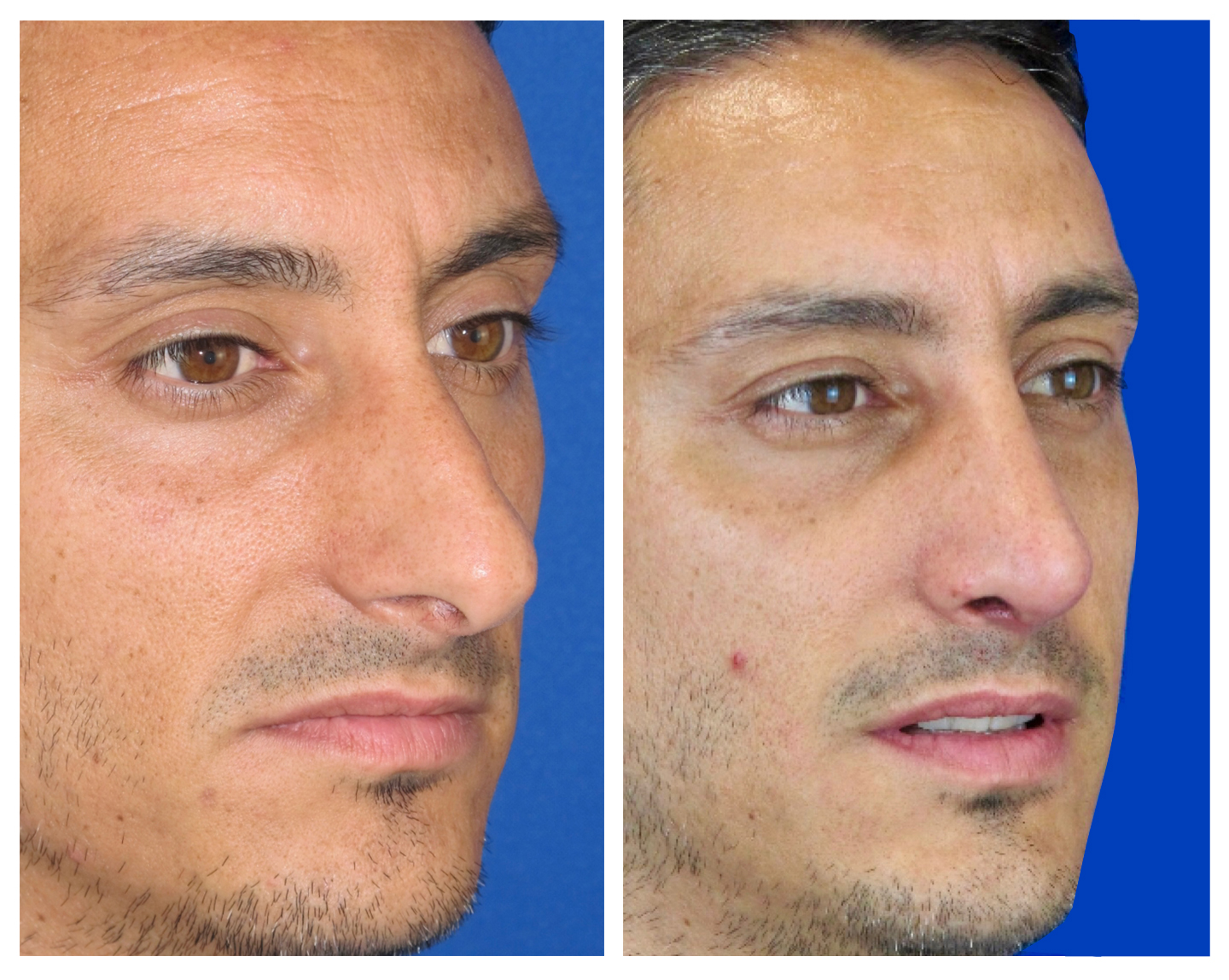Resultados Rinoplastia Funcional