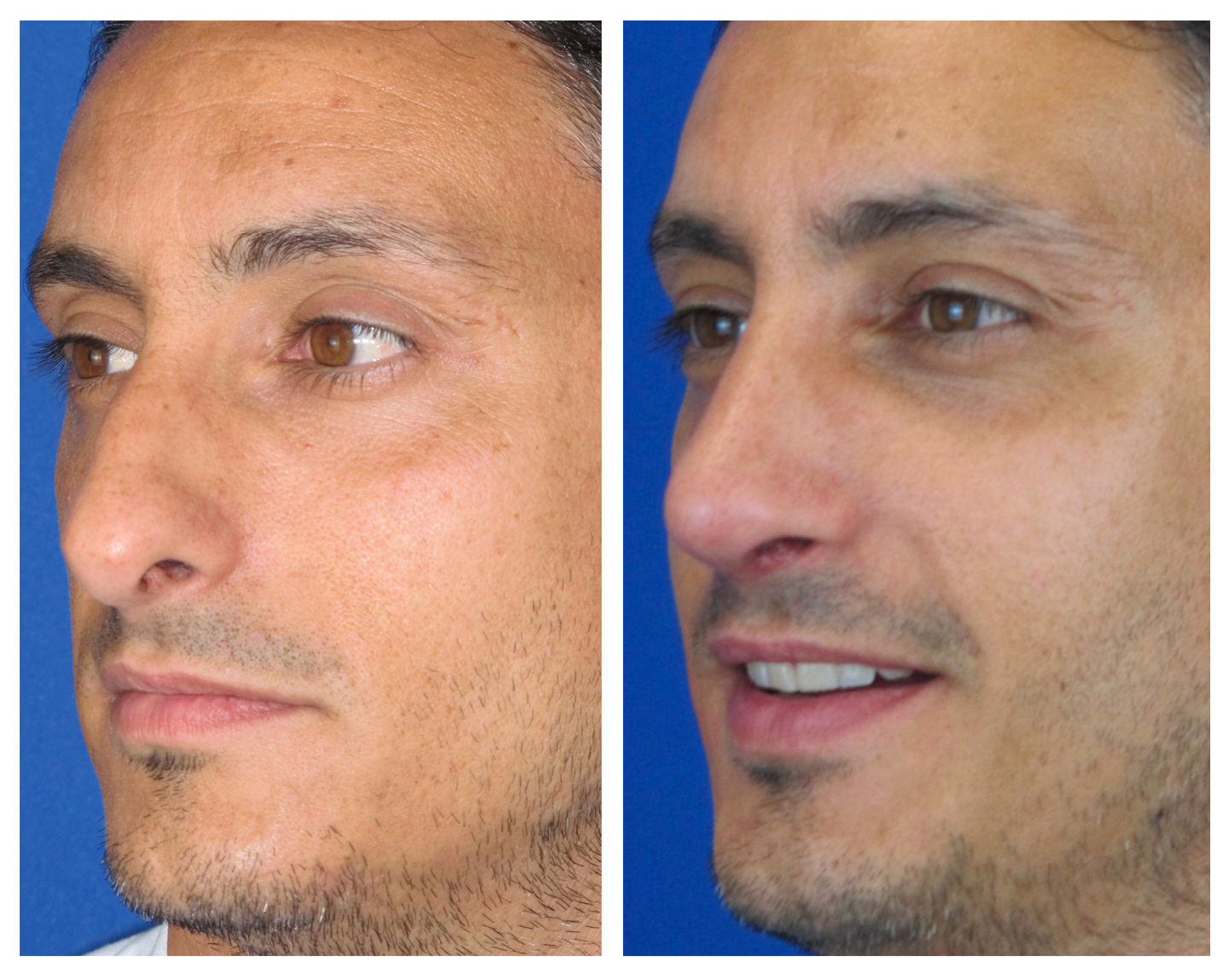 Resultados Rinoplastia Funcional