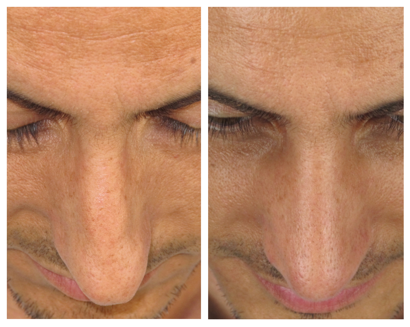Resultados Rinoplastia Funcional